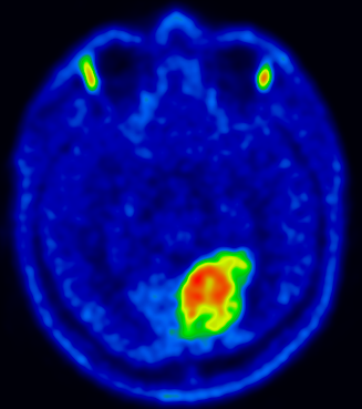 Позитронно-емісійна томографія (ПЕТ кт) головного мозку з метіоніном