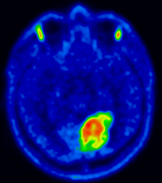 позитронна емисионна томография (PET CT) на мозъка с метионин