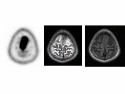 A pozitronemissziós tomográfia (PET CT) az agy a metionin (metionin) A pozitronemissziós tomográfia (PET CT) az agy metioninnal