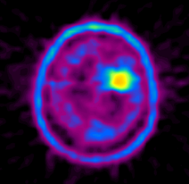 Posologie tomografie cu emisie de pozitroni (pet kt) a creierului cu metionină