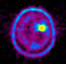 A pozitronemissziós tomográfia (PET CT) az agy a metionin (metionin) A pozitronemissziós tomográfia (PET CT) az agy metioninnal