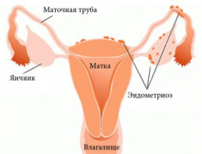 Cauze, simptome și tratamentul endometriozei (fotografie)