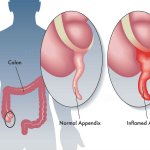 Cauzele apendicitei, precum și formele și simptomele acestei boli