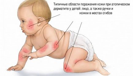 Utilizarea emulsiei de dermatită prenatală la copii și adulți
