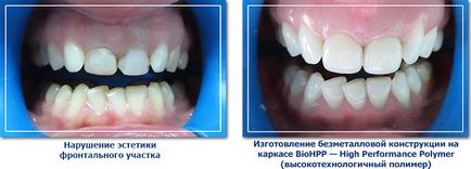 Протезування зубів в Молдові - новітні технології в clasicdent