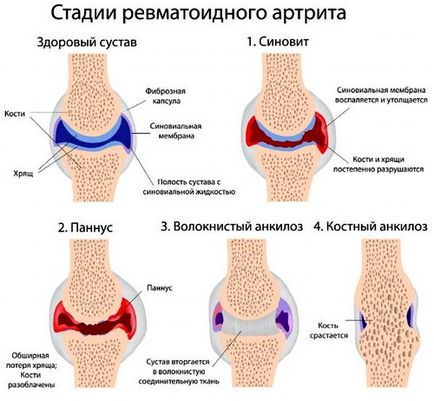 Ревматоїдний артрит перші симптоми