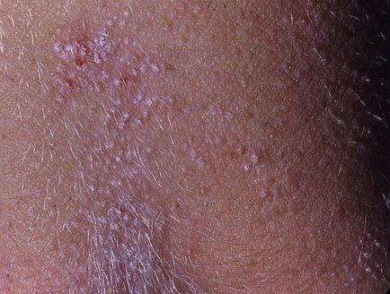 Шіповідний лишай на шкірі як розпізнати і вилікувати патологію