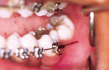 Швидка ортодонтическая допомогу - лікар ортодонт в москві, лікування брекетами і елайнери прикусу у