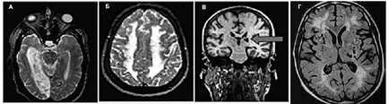 Stadiul de demență vasculară, gradul, diagnosticul