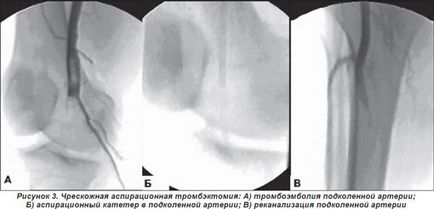 Modern kezelési módszerek az akut trombózis és embólia a perifériás artériák (személyes tapasztalat)