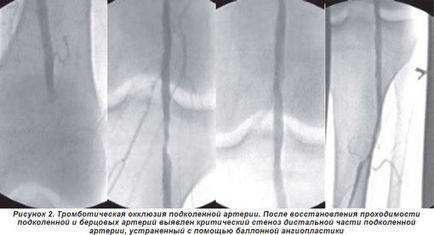 Metode moderne de tratament a trombozei acute și embolismului arterelor periferice (experiență proprie),