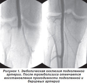 Metode moderne de tratament a trombozei acute și embolismului arterelor periferice (experiență proprie),