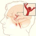 Spasmul vaselor cerebrale simptome, tratament, comprimate
