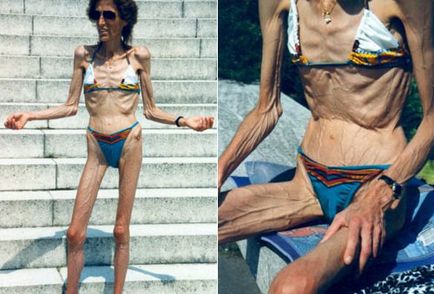 Consecințele aspre ale anorexiei (35 de fotografii), pulsul