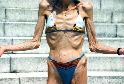 Consecințele aspre ale anorexiei (35 de fotografii), pulsul