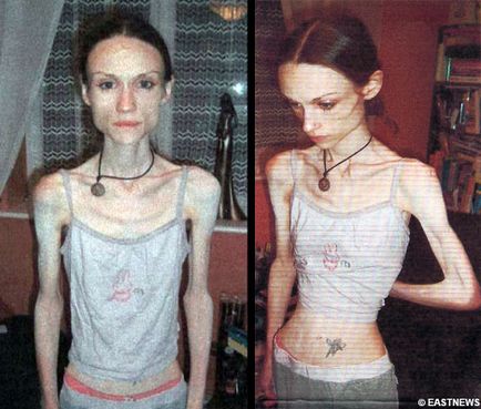 Страшні наслідки анорексії (35 фото), pulson