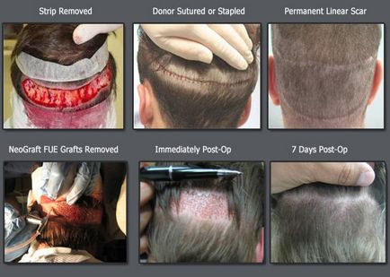 Трансплантація волосся метод strip vs fue