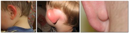 У дитини почервоніло вухо що робити, якщо опухла мочка, зовні або всередині раковини