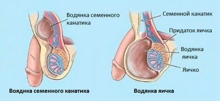 Urologie - edem al testiculelor (hidrocel)