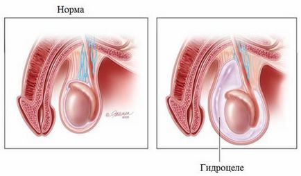Urologie - edem al testiculelor (hidrocel)
