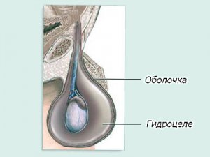 Водянка яєчка після операції варикоцеле діагностика і лікування