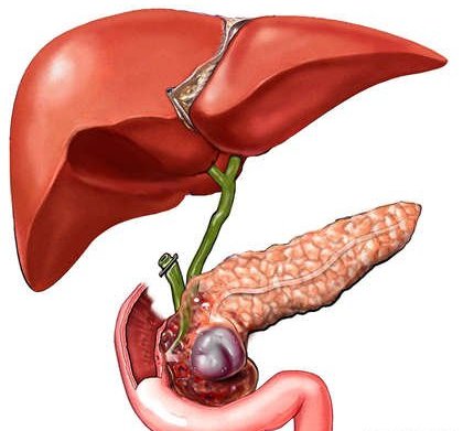 Pancreatită secundară și tratamentul acesteia