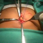 Tratamentul chirurgical al diastazei și herniei ombilicale după naștere, zaplyushki