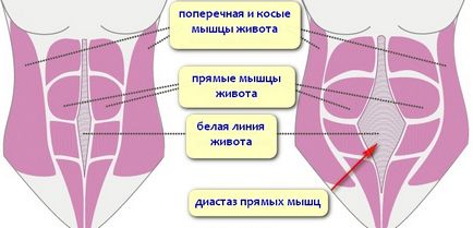 Tratamentul chirurgical al diastazei și herniei ombilicale după naștere, zaplyushki