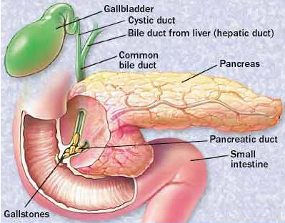 Pancreatită secundară cronică