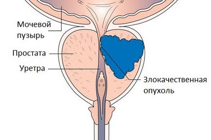 prostată după prostatită
