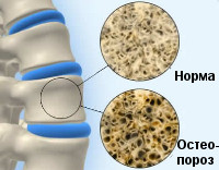 Osteoporoza juvenilă - cauze, simptome, diagnostic și tratament