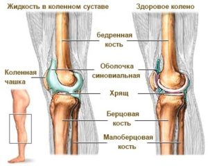 Рідина в колінному суглобі причини і лікування