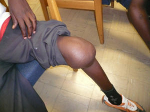 Fluidele cauzate de articulația genunchiului și tratamentul