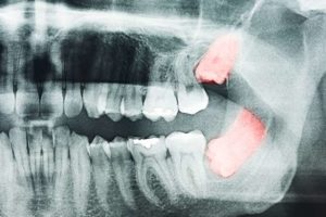 Înțelepciunea dinților pentru a trata sau pentru a șterge merită să fie tratată sau protetică