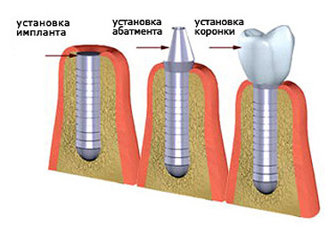 Implanturi dentare