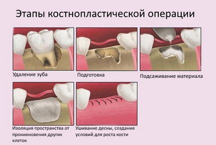 7 Питань про регенерації кісткової тканини - perfectsmile - центр мікроскопной стоматології та кісткової