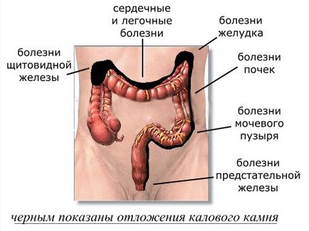 Активоване вугілля для очищення організму як приймати, відгуки