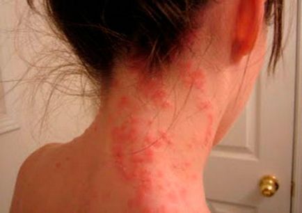 Алергія на глід симптоми, лікування