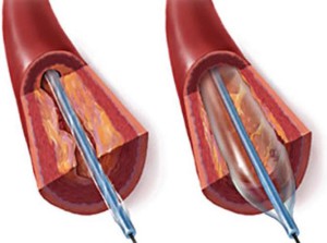 Angioplastie și stenting al arterelor coronare și vaselor celor mai bune clinici din lume