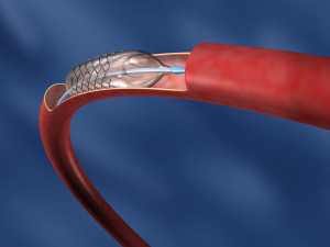 Angioplastie și stenting al arterelor coronare și vaselor celor mai bune clinici din lume