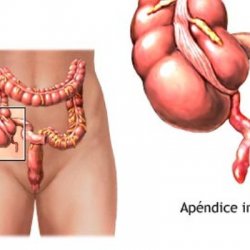 Apendicular abces - rezultat al apendicitei acute - bisturiu - medical