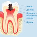 Болить зуб під коронкою при натисканні