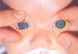 Чим небезпечна вроджена глаукома у новонародженого