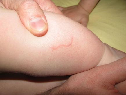 Ce este sub pielea unui copil și cum să se ocupe de el (foto)
