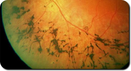 Що таке ретиніт сітківки ока