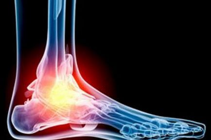 Deformarea artrozei (osteoartritei) piciorului, simptome, tratament, masaj