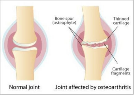 Дієта при артрозі колінних суглобів рекомендації