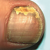 Designul unghiilor - bolile unghiilor