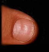Designul unghiilor - bolile unghiilor