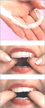 Acasă albirea dinților cu ajutorul gurii de protecție - stomatologie